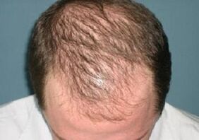 causas de la caída del cabello