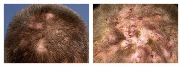 Abscesos que socavan la foliculitis de Hoffmann