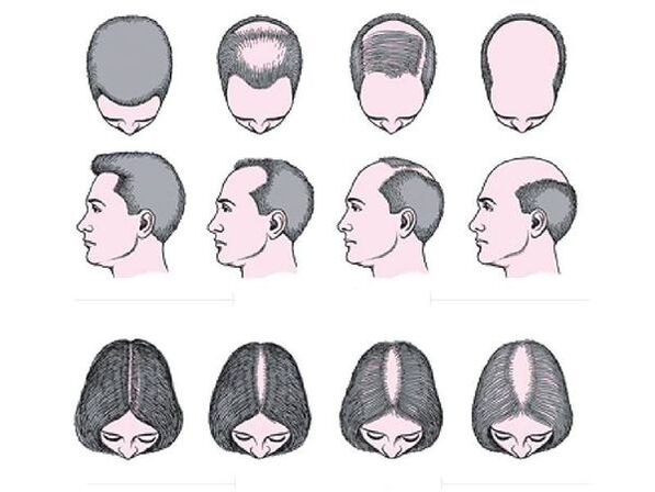 Alopecia androgenética en hombres y mujeres.