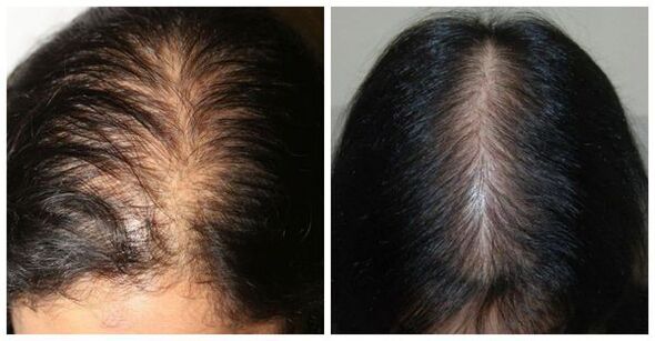 Caída del cabello en las mujeres.