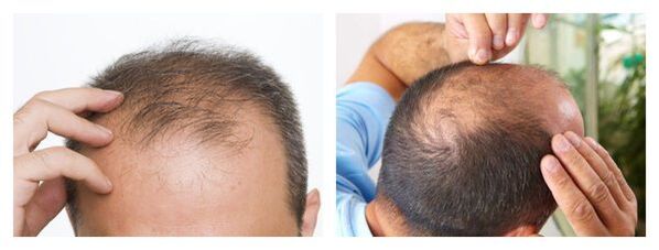 Caída del cabello en los hombres.