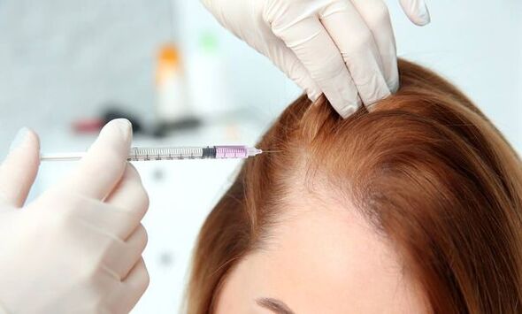 Mesoterapia para la calvicie
