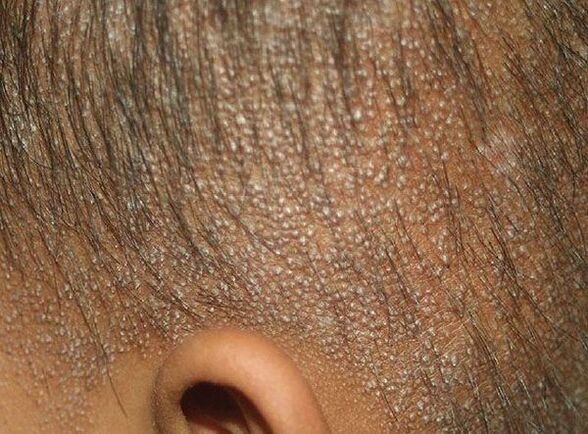 mucinosis folicular