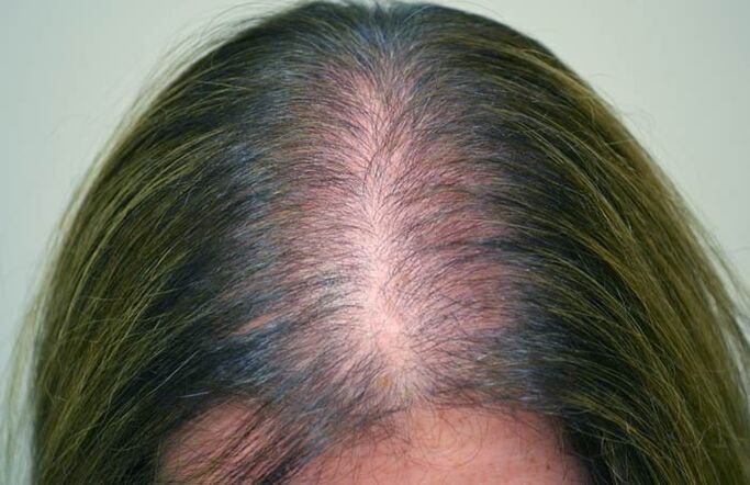 Alopecia (calvicie) en mujeres
