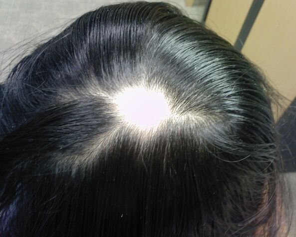 Alopecia areata o alopecia areata en mujeres