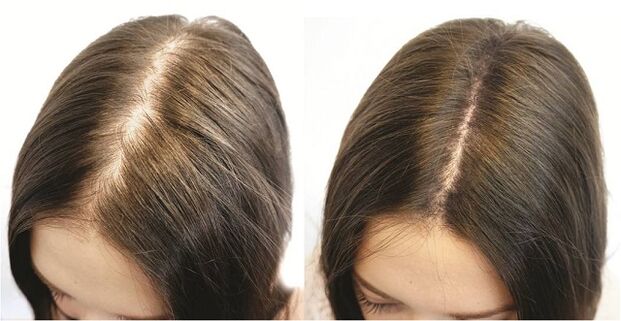 El resultado del tratamiento oportuno de la alopecia en mujeres.