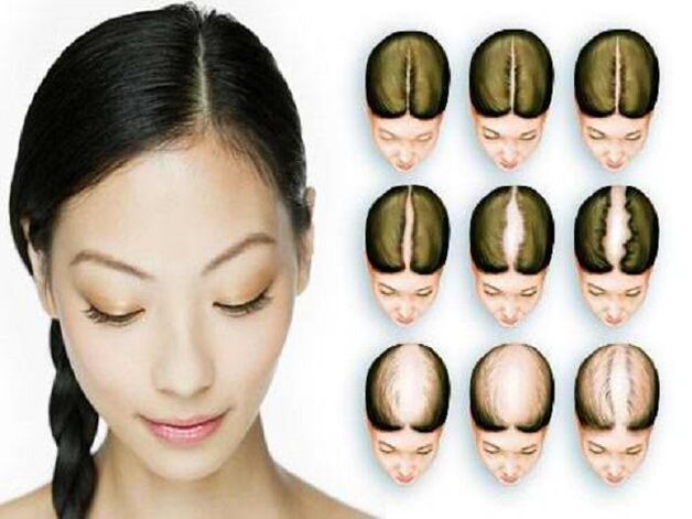Etapas de la alopecia en la mujer