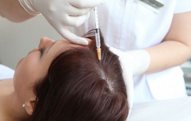 Mesoterapia en el tratamiento de la alopecia femenina