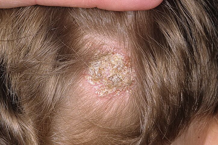 Tipo seborreico de alopecia en mujeres.