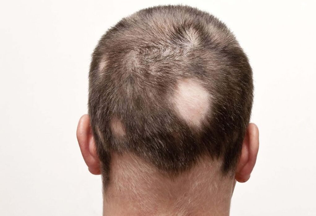 Alopecia anidante (focal) de la cabeza.