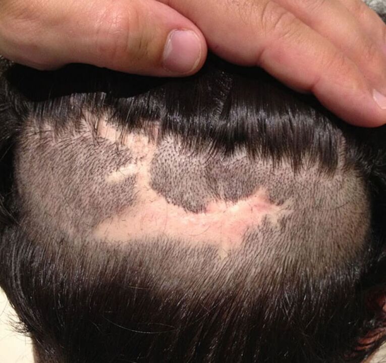 alopecia cicatricial del cuero cabelludo