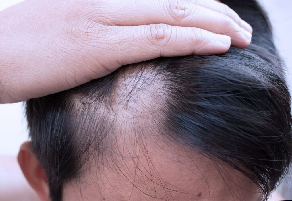 alopecia difusa de la cabeza