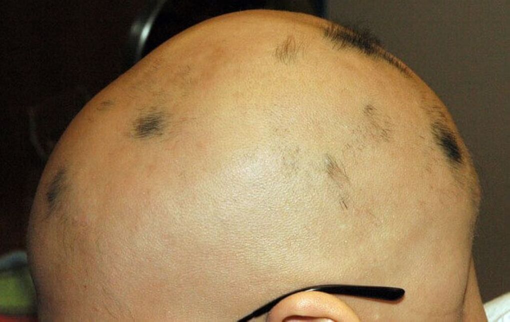 alopecia total del cuero cabelludo en un hombre