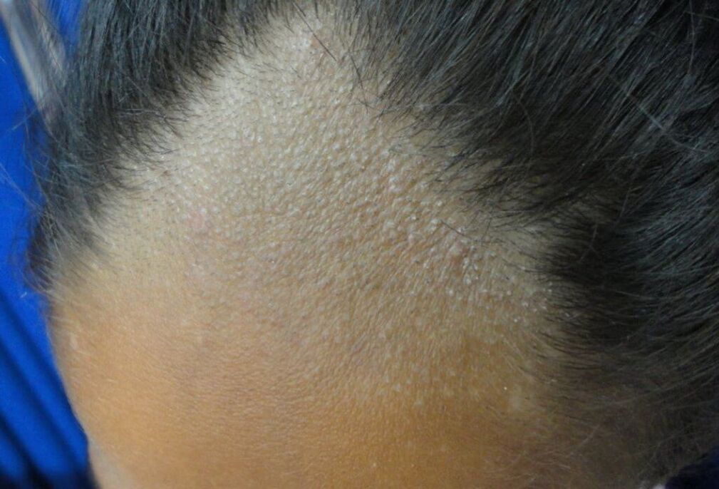 infección del cuero cabelludo en un hombre