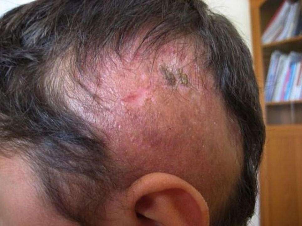 área de lesión del cuero cabelludo en un hombre
