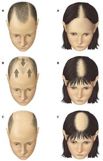 Alopecia androgénica en hombres y mujeres.