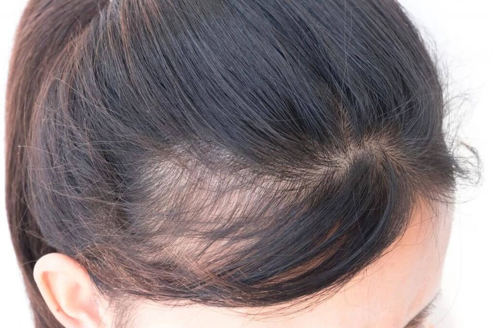 Alopecia androgénica en mujeres.