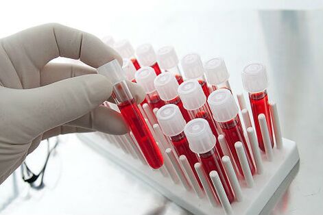 Análisis de sangre para prescribir un tratamiento individual para la alopecia