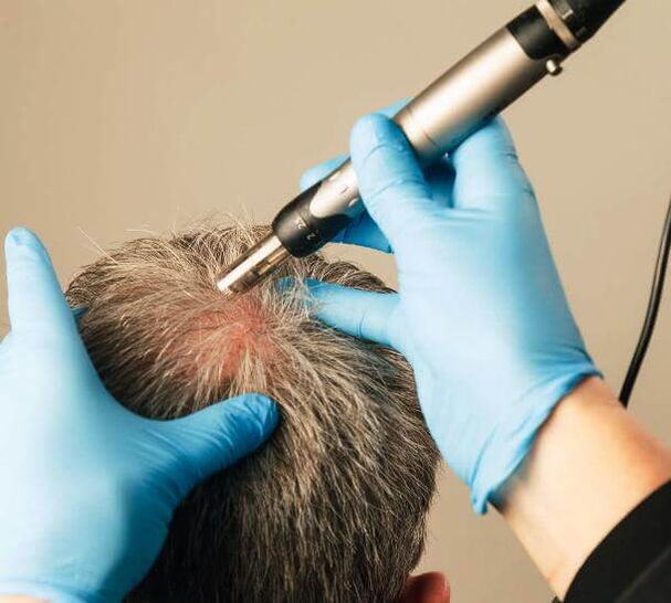 Fisioterapia para el tratamiento de la alopecia androgénica