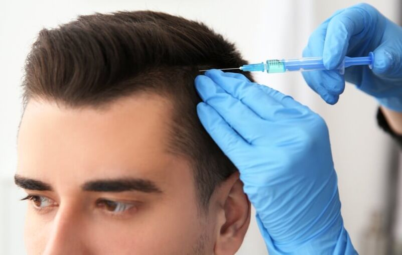 Mesoterapia para estimular el crecimiento del cabello en la alopecia androgénica