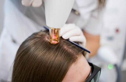 Terapia con láser para la alopecia androgenética